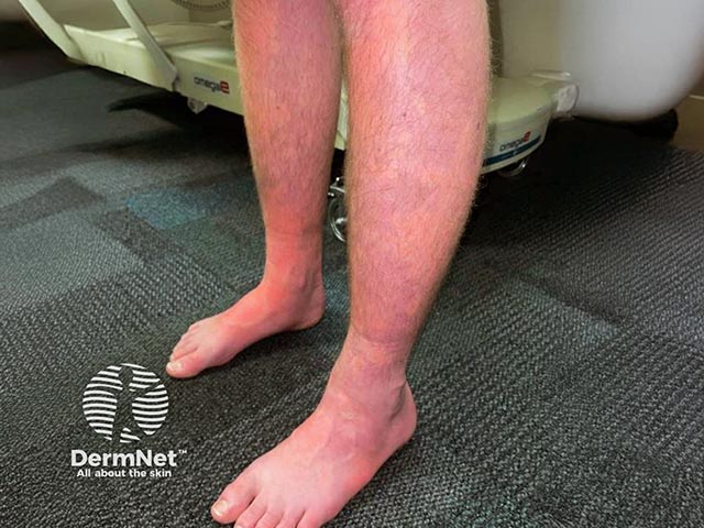 Bier spots (white macules due to diminished blood flow) on the legs