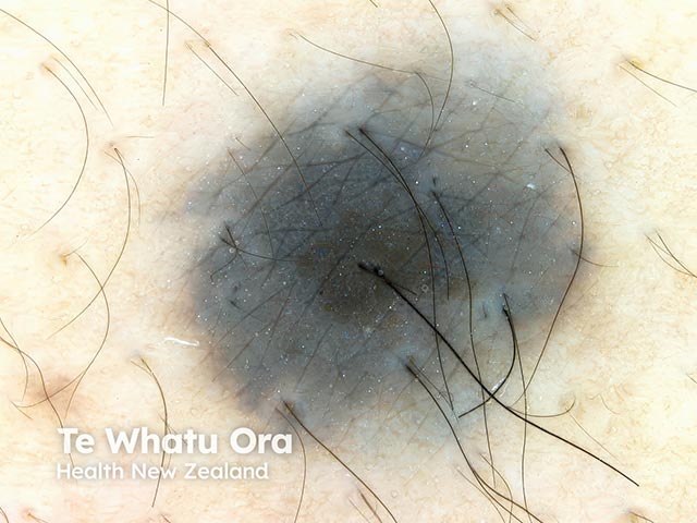 Dermoscopy of a blue naevus