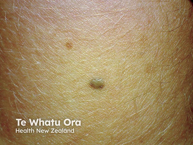 A homogeneous blue naevus on the forearm