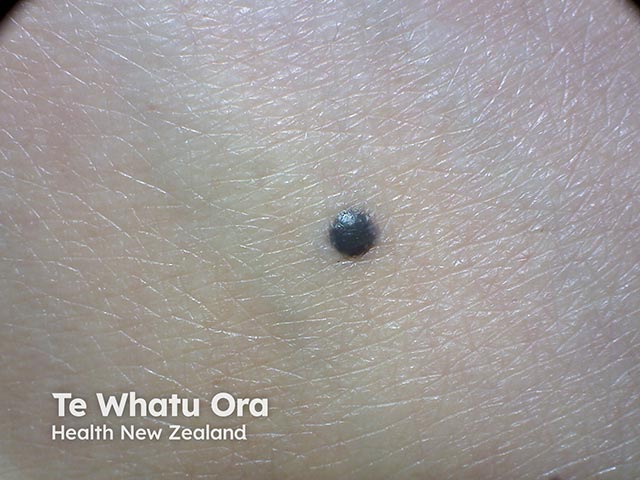 A typical steel-blue coloured blue naevus