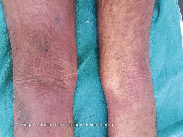 A morbilliform eruption arising with 3 days of fever in Chikungunya