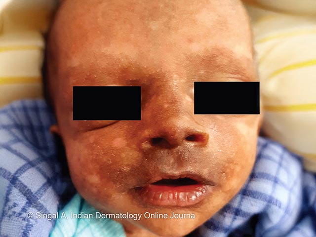 Facial hyperpigmentation around the nose and mouth in Chikungunya