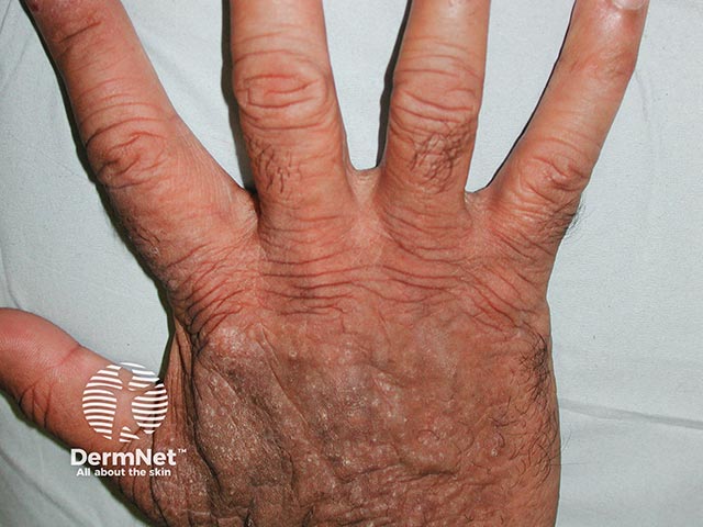 Chronic actinic dermatitis on the dorsal hand - note sparing of the web spaces