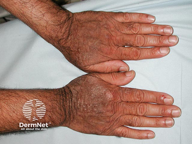 Lichenified chronic actinic dermatitis on the dorsal hands