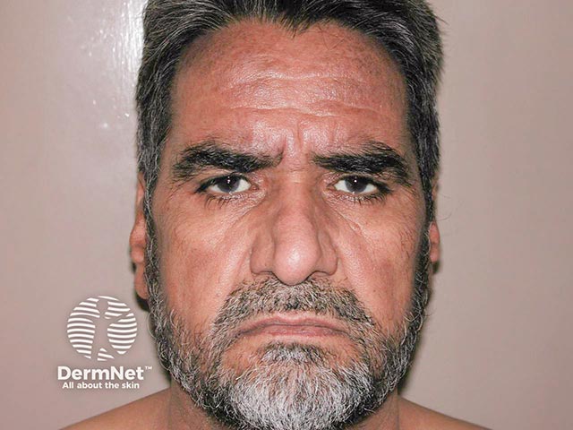 Chronic actinic dermatitis on the forehead