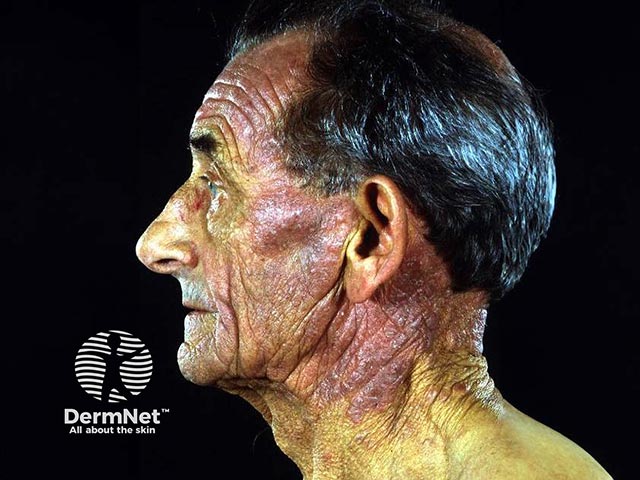 Chronic photosensitivity dermatitis