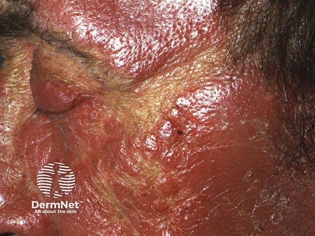 Severe chronic actinic dermatitis - note the sparing within the light-shielded skin crease