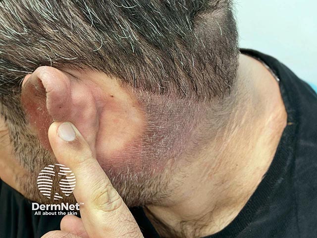 Pigmented chronic actinic dermatitis - note the cut-off at the neck line, and sparing below and behind the ears