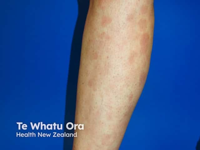 Patches of CSSD on the lower leg