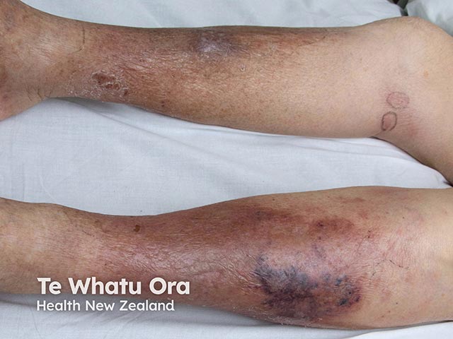 A haemorrhagic cellulitis-like eruption due to cryptococcosis (cryptococcal fungal infection)