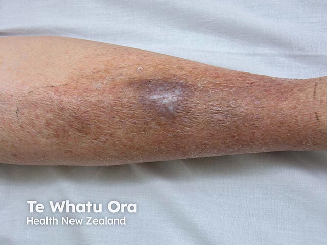 A haemorrhagic cellulitis-like eruption due to cryptococcosis