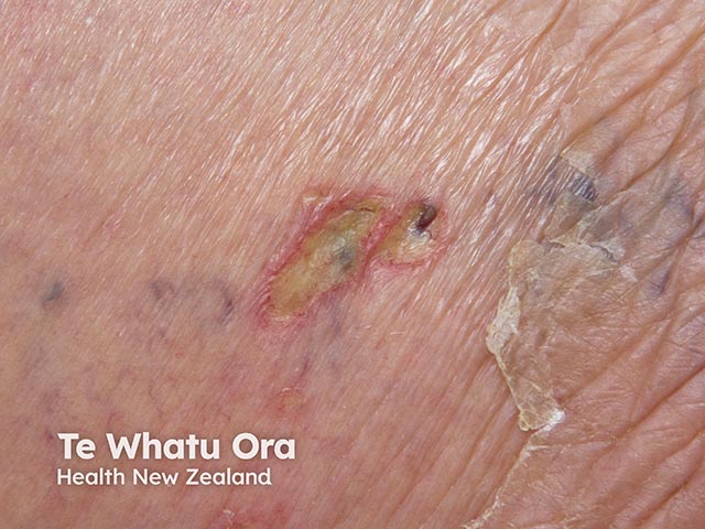 An ulcerated area due to cryptococcosis