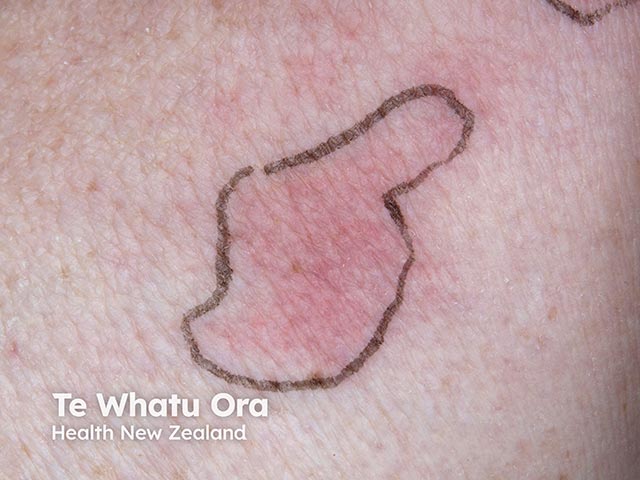 Spreading erythema due to disseminated cryptococcosis