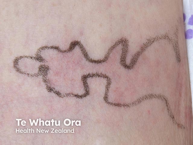 Spreading erythema due to disseminated cryptococcosis