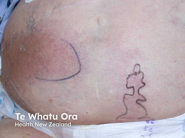 Spreading erythema due to disseminated cryptococcosis