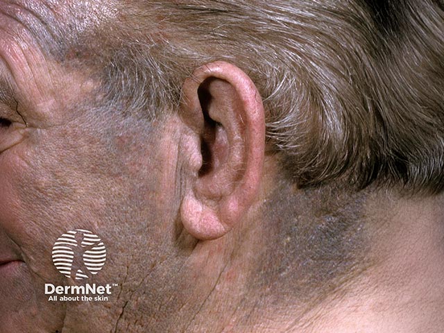 Minocycline facial pigmentation used for facial rosacea