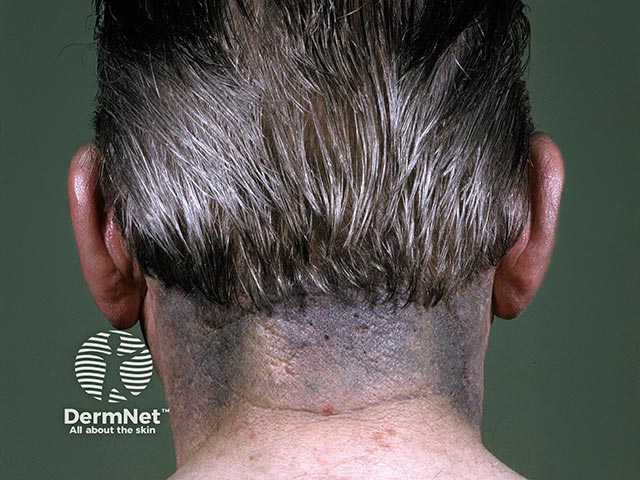 Minocycline-induced pigmentation of the neck
