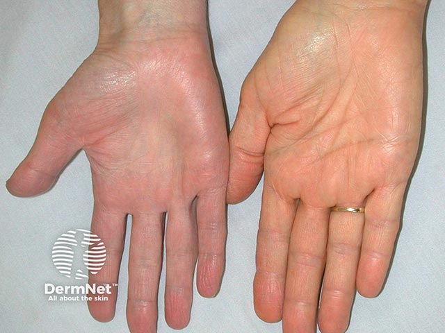 Yellow pigmentation of the palm due to mepacrine ingestion - it is often most visible on the face. The right palm is normal by contrast