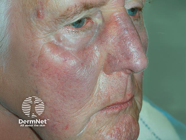 Blue facial and nasal pigmentation due to amiodarone