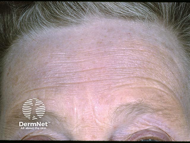 Chrysiasis - blue-grey pigmentation of the forehead due to long-term gold administration for rheumatoid arthritis
