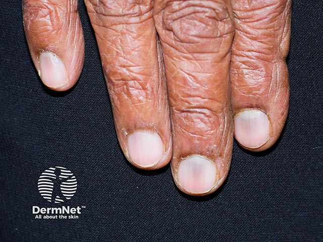 Blue-black nail pigmentation due to long-term antimalarial therapy