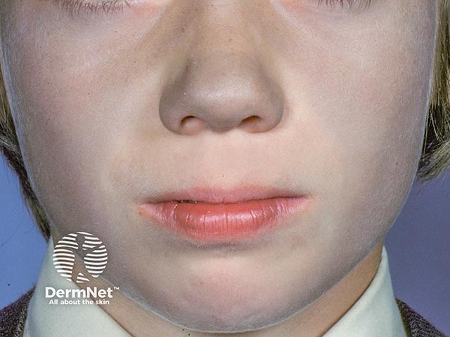 Blue pigmentation most evident on the nose due to amiodarone