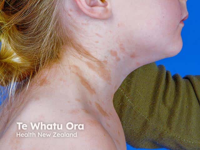 Juvenile mastocytosis: red-brown macular lesions on the neck.  They are likely to resolve over the next few years