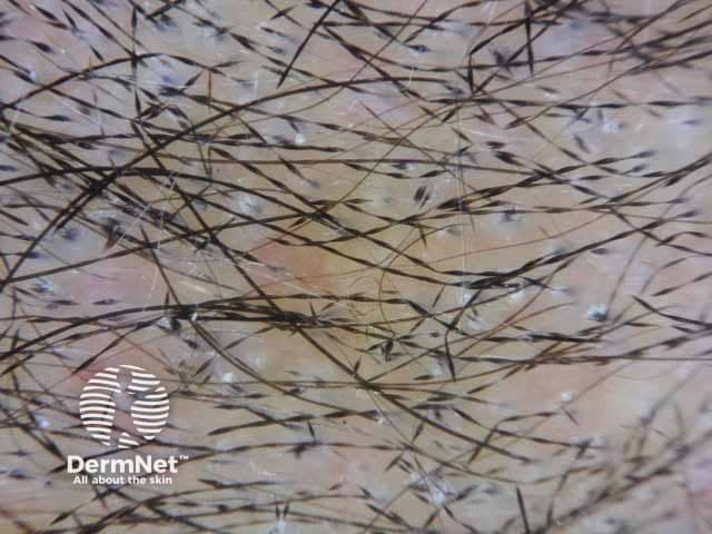 Monilethrix presenting with constrictions regularly arranged along the hair shaft