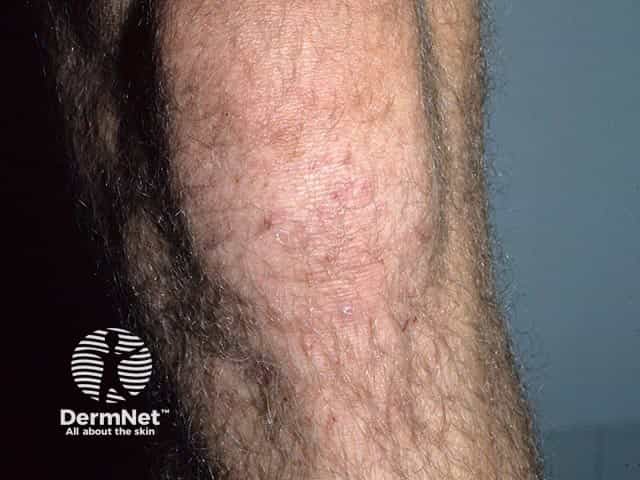 Excoriated vesicles on the knee in dermatitis herpetiformis. A single intact vesicle is visible over the tibial tubercle