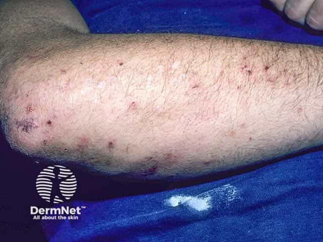 Excoriated vesicles on the arm in dermatitis herpetiformis. A few intact vesicles are evident