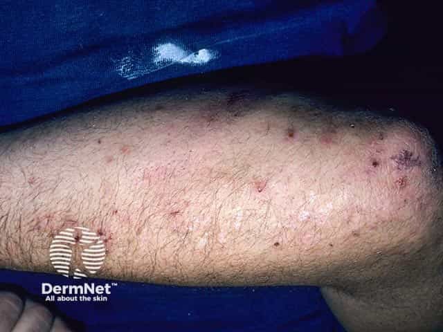 Excoriated vesicles on the arm in dermatitis herpetiformis. A few intact vesicles are evident