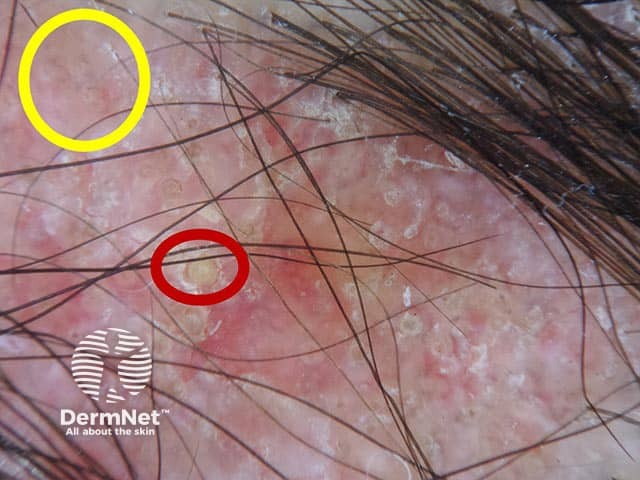 Follicular plugging (red circles) and speckled pigmentation (yellow circle) in discoid lupus erythematosus