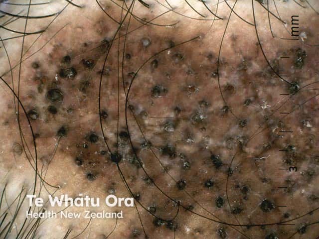 erythematosus Discoid lupus erythematosus Scarring alopecia with follicular plugging in discoid lupus erythematosus