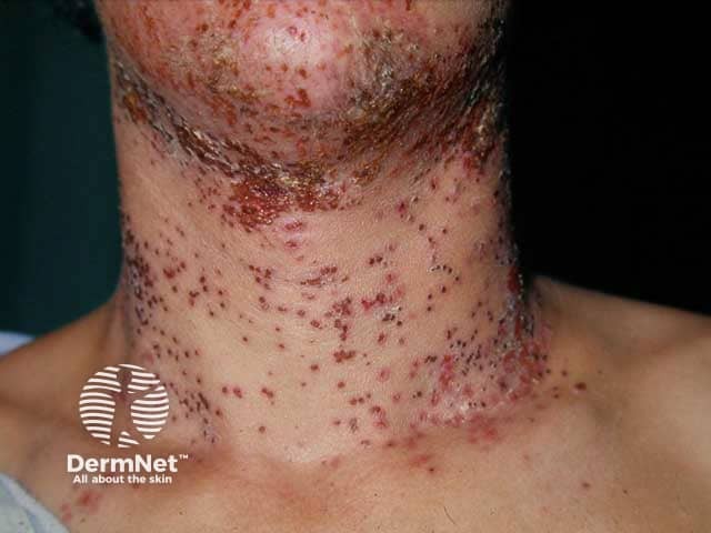 Monomorphic erosions due to eczema herpeticum in HIV infection