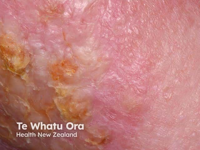 Hyperkeratotic changes arising in chronic lower leg lymphoedema - elephantiasis nostras verrucosa