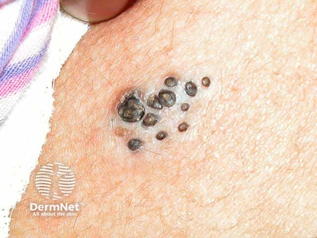 Comedo naevus on the abdomen