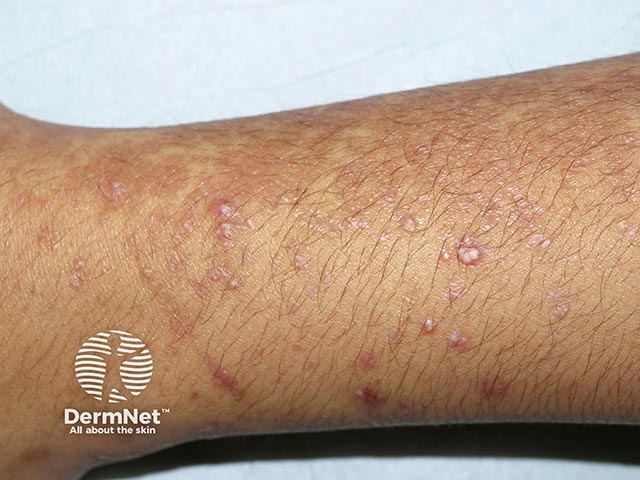 Milia on the arms due to epidermolysis bullosa acquisita