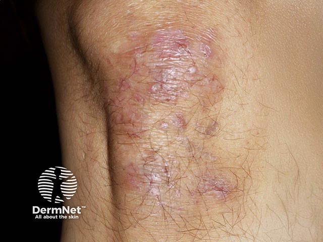 Milia on the knees after healing of blisters due to epidermolysis bullosa acquisita