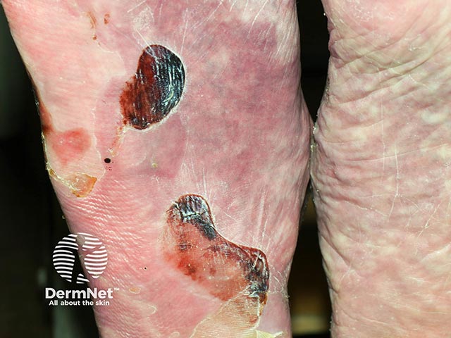 Haemorrhagic blisters on the soles of the feet due to epidermolysis bullosa acquisita