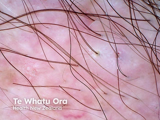 Dermoscopy of mild folliculitis keloidalis (also known as acne keloidalis nuchae) - there is scarring and hair loss