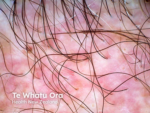 Dermoscopic image of folliculitis keloidalis (acne keloidalis nuchae) with scarring and tufting ot the nape of the neck