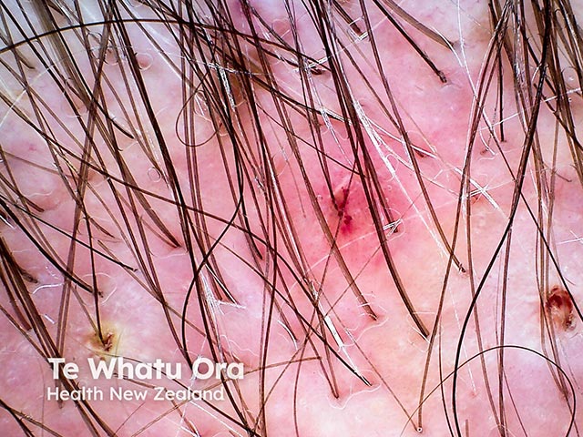 Dermoscopy of mild folliculitis keloidalis - there is scarring and hair loss