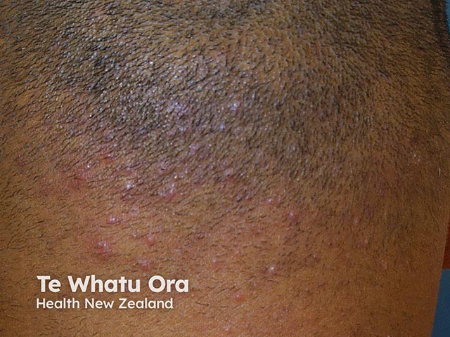 Early papular lesions on the nape of the neck in folliculitis keloidalis nuchae