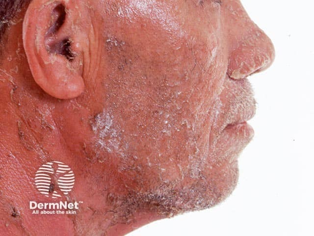 Erythema and desquamation of the facial skin after resolution of pustules in generalsied pustular psoriasis