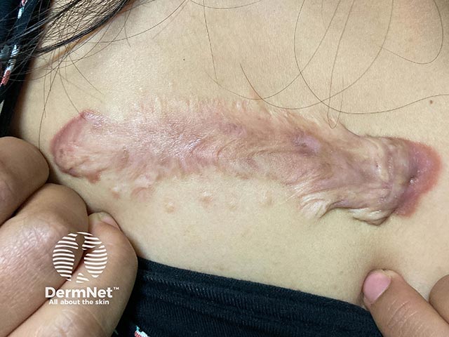 A large keloid scar on the presternal area
