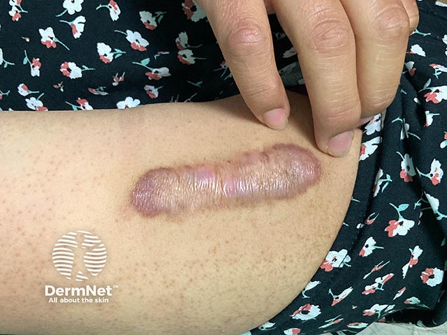 A keloid scar on the upper arm