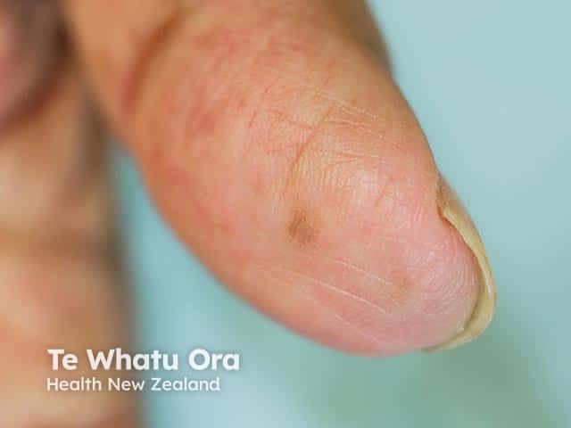 Finger pulp pigmentation in Laugier-Hunziker syndrome
