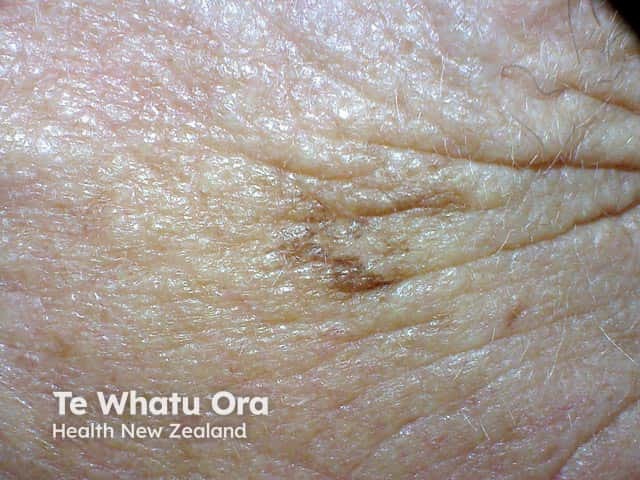 An irregularly pigmented and marginated macular lesion due to lentigo maligna on the temple