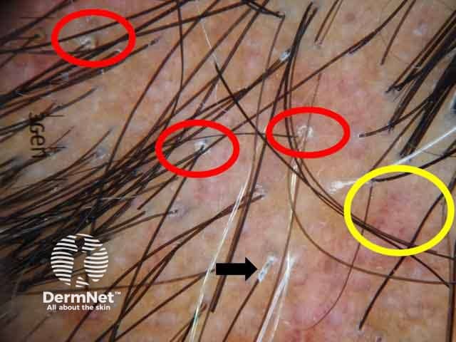 Perifollicular scales (red circles, peritubular cast (black arrows) and blue grey dots (yellow circles) in lichen planopilaris
