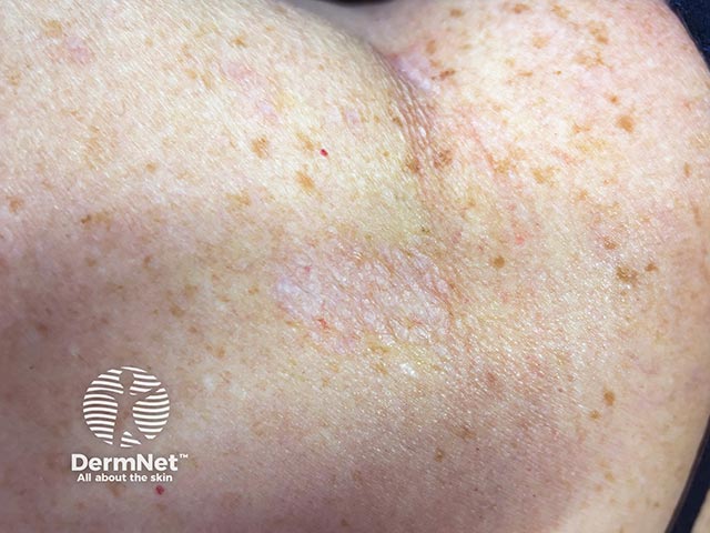 A pale scaly plaque on the trunk due to extragenital lichen sclerosus